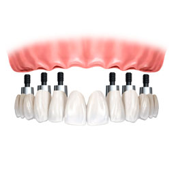 Implante Dentário - Excelência Odontologia - Riacho Fundo